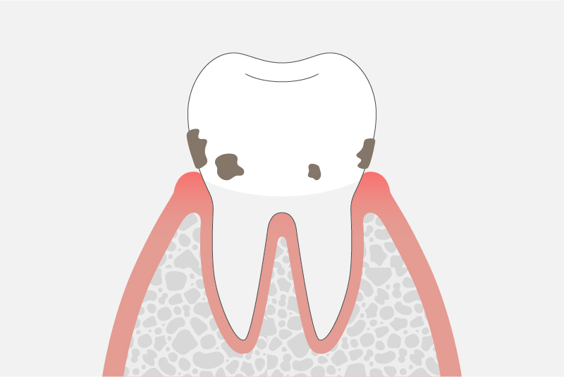 >軽度歯周炎